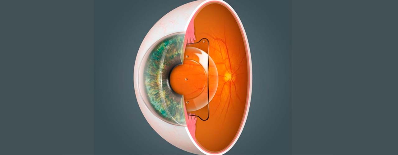 La ICL (Implantable Collamer Lens) es una lente intraocular que se implanta sin extraer el cristalino natural