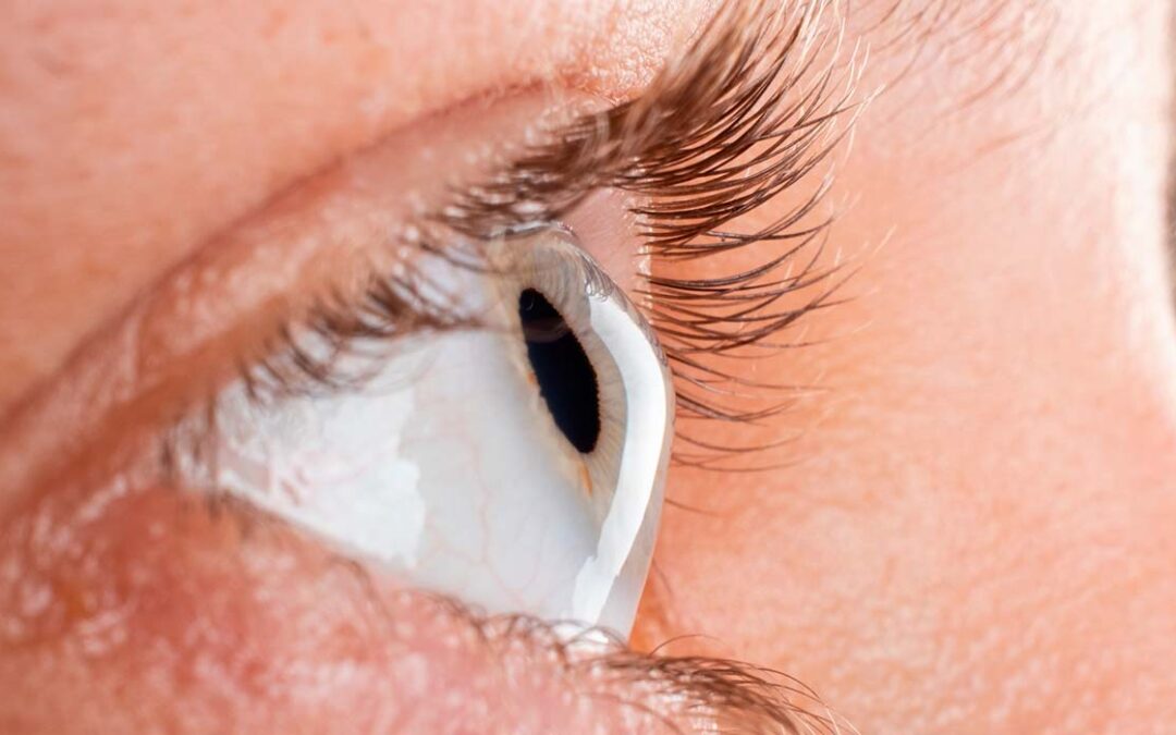 Lentes esclerales para queratocono: visión clara sin cirugía