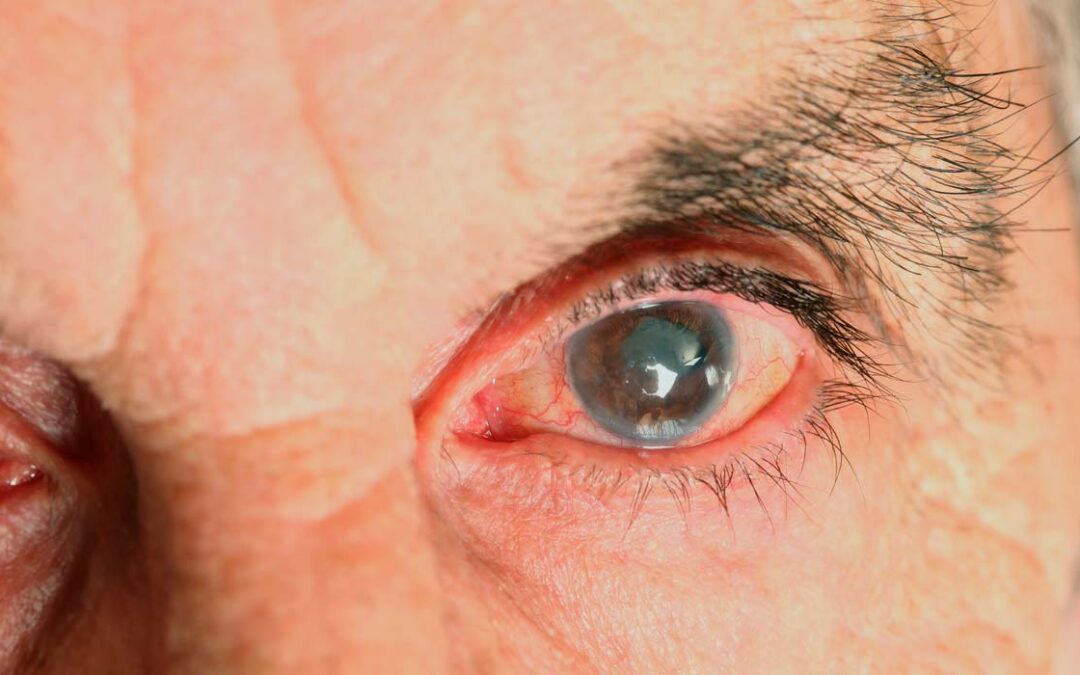 ¿Por qué aparecen las cataratas? Tipos, cuándo operarlas y cómo es la cirugía