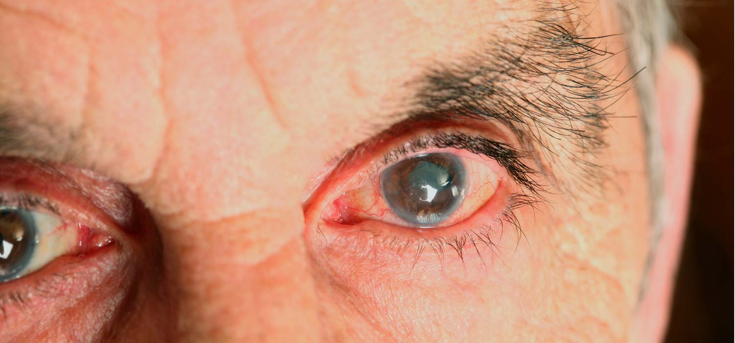 ¿Por qué aparecen las cataratas?