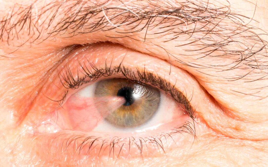 Cirugía de Pterigión con Autoinjerto y Pegamento Tisular en CDMX