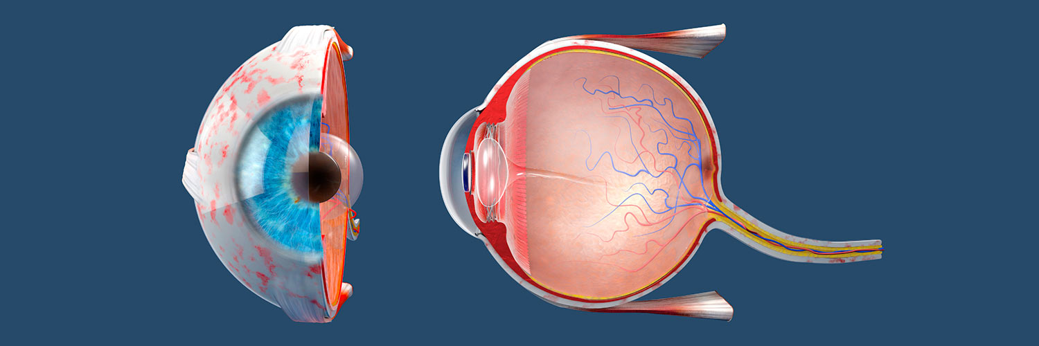 Queratocono en adolescentes