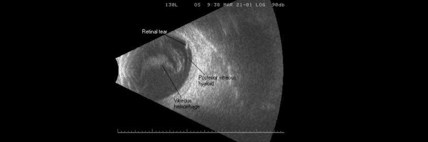 Ultrasonido Ocular