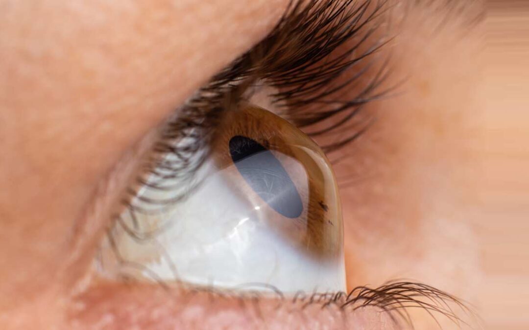 Lentes esclerales: mucho más que queratocono