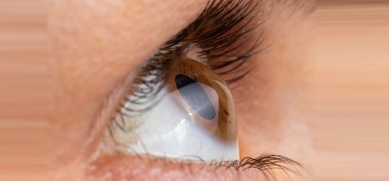 Lentes esclerales: mucho más que queratocono