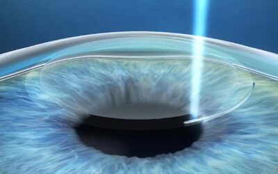 Femtolasik, SMILE y Streamlight: las cirugías láser más avanzadas para dejar de usar lentes