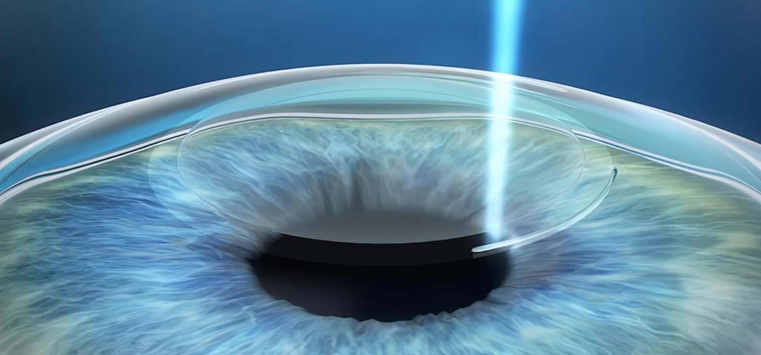 Femtolasik, SMILE y Streamlight: las cirugías láser más avanzadas para dejar de usar lentes