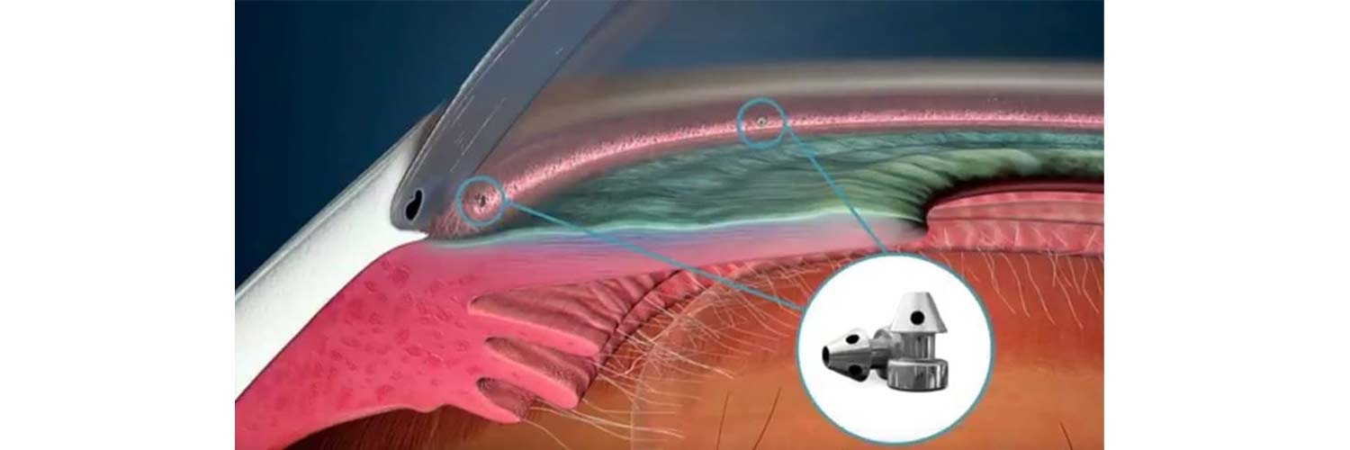 MIGS: cirugía mínimamente invasiva para glaucoma