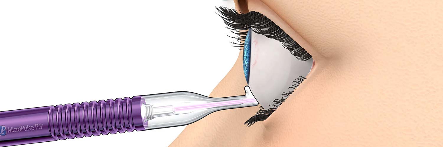 Láser micropulsado: tratamiento con menor daño térmico