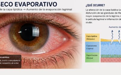 Ojo seco evaporativo: causas, síntomas y tratamientos modernos